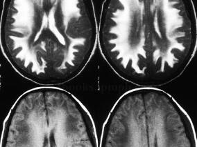 女20岁,全头持续性胀痛,基层治疗数天病情无好转