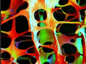 卵巢早衰引起的骨流失:激素替代治疗vs复方口服避孕药