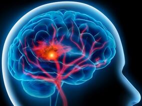 多学科讨论：卒中后静脉阿替普酶后机械血栓清除术vs阿替普酶单药