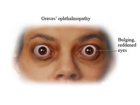 女66岁，怕热、多汗、心悸、手颤半年，加重伴胸闷气短、双下肢水肿1个月