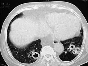 男61岁,咳嗽、咳痰、咯血25天,影像示双肺空洞病变