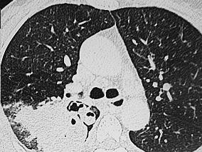 女48岁,咯血伴胸痛8年,加重1周,CT示右上肺后段见斑片状、团块状影