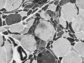 男43岁,令人困惑的四肢无力,外院诊断为颈椎病,治疗无效