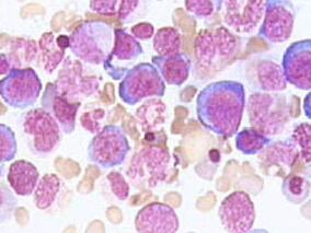 男54岁，心悸、手抖、消瘦10个月，行走不稳20天，意识障碍2天