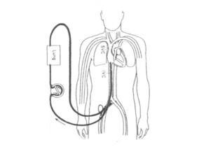 米卡芬净在体外膜肺氧合支持的婴儿中的药代动力学和安全性