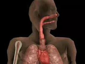 女42岁,反复发作性喘息20年,加重1周