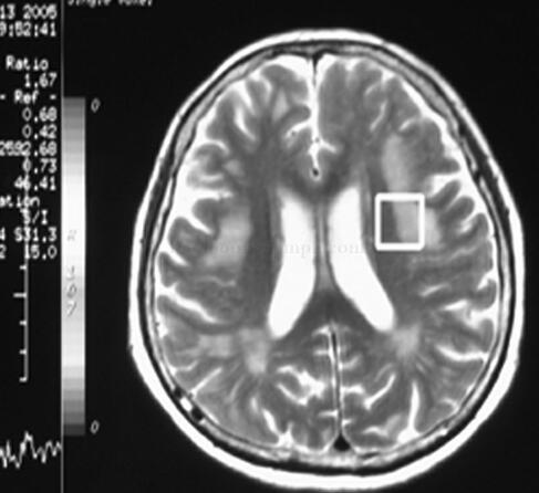 女75岁,反复肢体麻木无力16年和视力下降2月