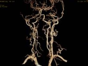 神经血管介入操作过程中肝素过敏致呼吸心跳骤停一例