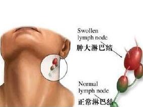 男54岁,发现淋巴结肿大10余天,以双侧颈部及腹股沟区肿大明显
