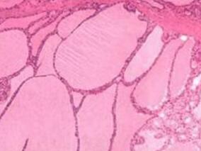 女34岁，心悸、乏力、怕热、多汗、手颤5年，恶心、纳差3个月