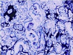 男45岁，少尿，腹胀，血肌酐进行性升高2周