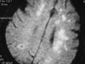 女66岁,言语不能、四肢活动不灵6天,加重1天