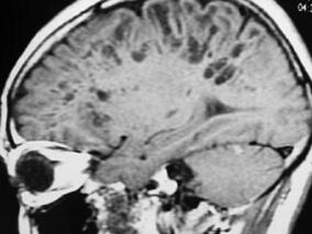 女60岁,2年来反复后枕部胀痛,按摩后可减轻