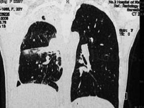 女23岁,右上肺囊肿切除术后持续咳嗽、咳痰、咯血3个月余