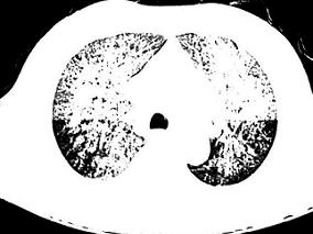 男60岁,咳嗽、呼吸困难进行性加重、肺部弥漫性片状高密度影