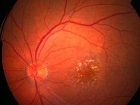 非甾体类抗炎药降低白内障术后的黄斑水肿风险？