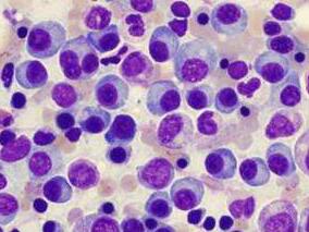 新药辈出时代多发性骨髓瘤初始治疗后早期复发预示结局不良