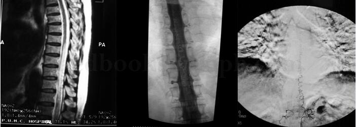 女76岁,双下肢无力3年,按膝关节骨质增生进行治疗无效