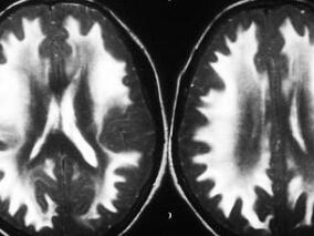 女20岁,头痛伴呕吐十余天,当地卫生院对症治疗数天无好转