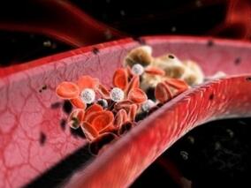 静脉血栓栓塞早期结局：利伐沙班优于传统抗凝治疗吗？