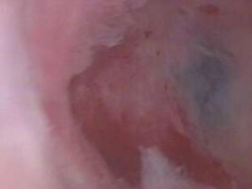 女41岁，恶心、呕吐6年，产后大出血，眉毛、腋毛、阴毛脱落