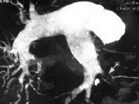 男64岁,反复发作性晕厥1年半,加重伴活动后胸闷气促1个月余