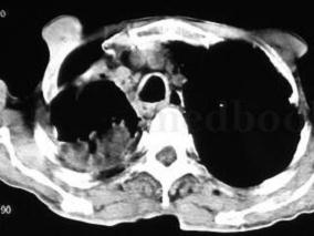 男69岁,咳嗽、咳痰28年,咯血、气促2年,加重并胸痛1个月余