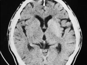 男73岁,右侧肢体不自主活动6天,否认家族中舞蹈病史