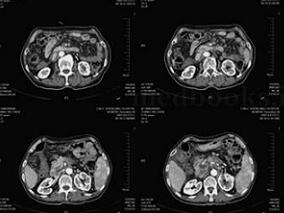 女71岁,以“腹胀、腹痛1月余,加重1天”为主诉入院