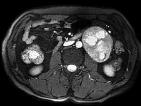 男38岁,两年余前无明显诱因出现左上腹隐痛,伴轻度腹胀,无腹泻