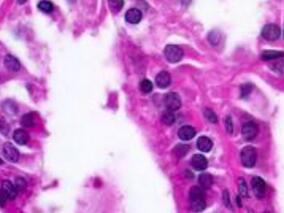 女32岁，心悸、多汗、腹泻14年，胸闷气短6个月，甲亢复发还是另有病因