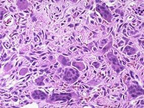 女69岁，精神异常2年，顽固便秘2个月，肛裂肠梗阻