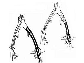 新VTE-BLEED评分或能准确预测VTE患者抗凝治疗的出血风险