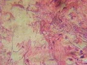 男72岁，间断头晕、腹胀、憋喘10余天，发现肾功能下降4天