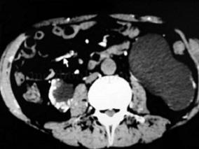 男35岁，肾移植后下肢皮肤溃疡1月余，移植肾失功还是有新发疾病