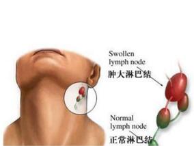 男56岁,确诊慢性淋巴细胞白血病4年,颈部淋巴结进行性增大10余天