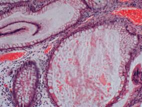 女35岁，泌乳、闭经7年，双下肢畸形2年，骨痛6个月，是甲亢吗？