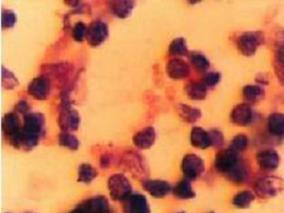 男43岁,咳嗽、活动后气促、间断发热8个月,左肺门占位性病变