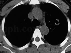男39岁,反复咯血3年,CT示肺结核,抗结核治疗无效
