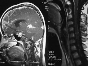 女12岁,右下肢酸胀无力8月,口服泼尼松缓解,视力减退2周,地米治疗后反加重