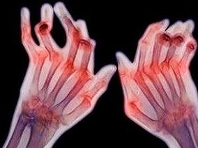 早期关节炎患者不同治疗策略下的持续缓解频率和时间