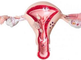 高脂血症患者使用他汀或可降低子宫肌瘤风险