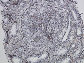 周身乏力3月，加重伴恶心10天，最终死亡，为何接连2次住院均被误诊？