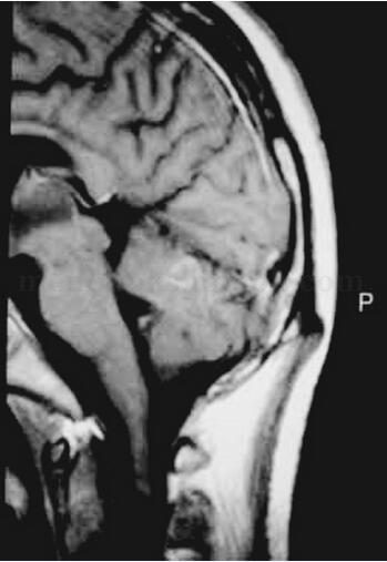 3次腰穿脑脊液常规细胞计数白细胞为0,1次脑脊液细胞学提示急性炎症,究竟患有何病?