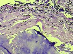 咳嗽2年,CT示双肺多发病灶,支气管表面覆盖坏死物,竟然不是气管炎