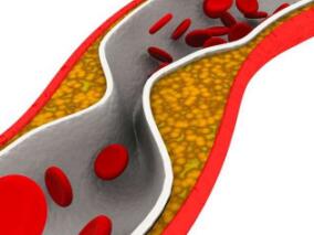 多学科讨论：USPSTF推荐75岁以下无CVD史成人使用低至中剂量他汀