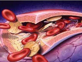 TAVR术中抗凝比伐芦定优于普通肝素?