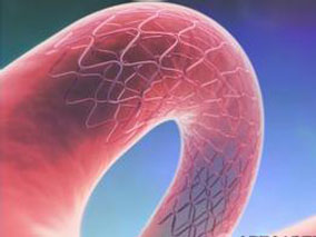 比伐芦定取代肝素后PCI患者的出血和支架血栓此消彼长