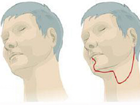 局部晚期头颈癌：西妥昔单抗+放疗vs顺铂+放疗