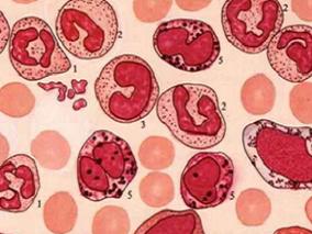 新发CML患者长期治疗结局：干细胞移植vs化疗